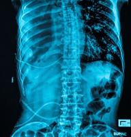 posición supina de la radiografía del abdomen foto