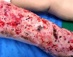 Abrasion wound, simulation photo