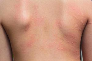 Allergic rash. photo