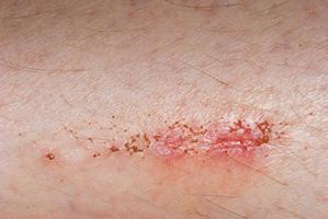 incrustation scab skin photo