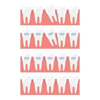 Braces isolated on white background vector