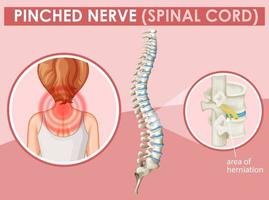 Diagram showing pinched nerve in human vector