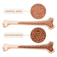 anatomía de la osteoporosis aislada vector