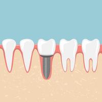 Human teeth and dental implant vector