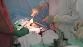 Surgeons sew up stomach of woman by needle and thread. Cesarean section. Nurse video