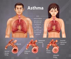 información educativa sobre pulmones asmáticos vector