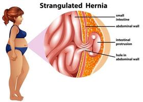 Strangulated hernia diagram vector