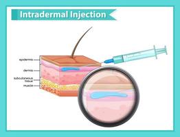 ilustración médica científica de la inyección intradérmica vector