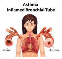 Asthma inflamed bronchial tube vector