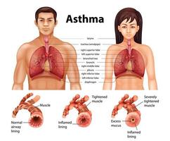 comparación de pulmón sano y pulmón asmático vector