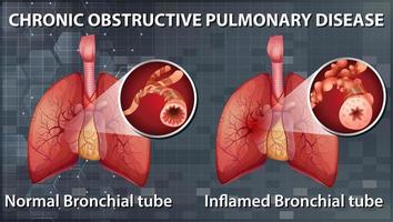 Chronic obstructive pulmonary disease vector