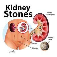 Informative illustration of kidney stones vector