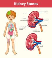 Kidney stones symptoms cartoon style infographic vector