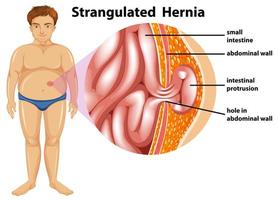 Man Strangulated Hernia Diagram vector