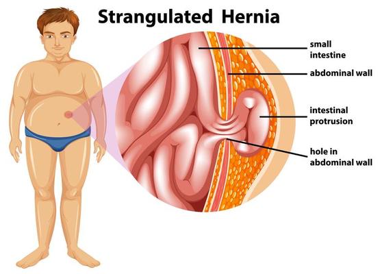 Man Strangulated Hernia Diagram