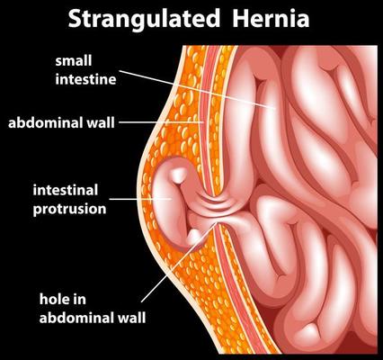 Strangulated Hernia Diagram for Education