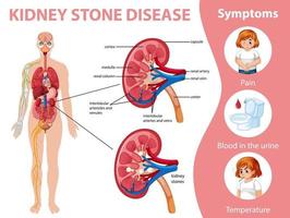 Kidney stones disease and symptoms infographic vector