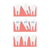 Braces vector design illustration isolated on white background