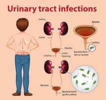 Ilustración informativa de infecciones del tracto urinario. vector