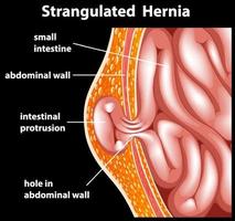 Strangulated hernia anatomy diagram vector