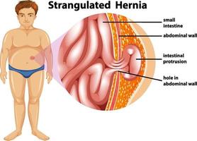 hombre con hernia estrangulada vector