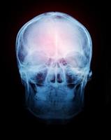 Film x-ray of human skull photo