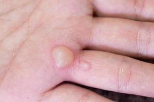 Female fingers are swollen after an accident