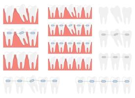 Braces vector design illustration set isolated on white background