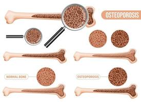 Osteoporosis vector design illustration set isolated on white background