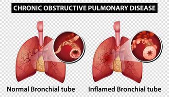 Diagram showing chronic obstructive pulmonary disease vector