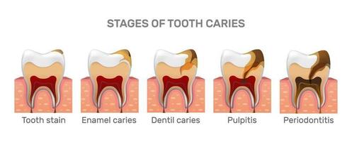 Tooth caries structure and full placement steps in realistic style. Stain, enamel caries, dentil, pulpitis, periodontitis. Gingiva. Vector illustration 3d.