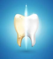 Tooth whitening in 3d style. Dental brushing of calculus and caries removal. Difference after brushing. Vector realistic illustration.