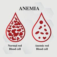 anemia cantidad de sangre roja deficiencia de hierro anemia diferencia de anemia cantidad de glóbulos rojos y síntomas normales ilustración vectorial médica. vector