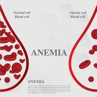 anemia cantidad de sangre roja deficiencia de hierro anemia diferencia de anemia cantidad de glóbulos rojos y síntomas normales ilustración vectorial médica. vector