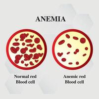 anemia cantidad de sangre roja deficiencia de hierro anemia diferencia de anemia cantidad de glóbulos rojos y síntomas normales ilustración vectorial médica. vector