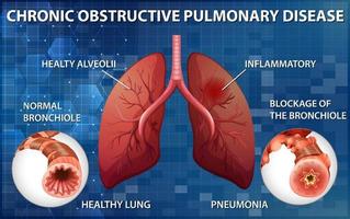 pulmón con enfermedad pulmonar obstructiva crónica vector