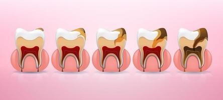 Estructura de caries dental y pasos de colocación completos en estilo realista. mancha, caries de esmalte, dentil, pulpitis, periodontitis. ilustración vectorial 3d. vector