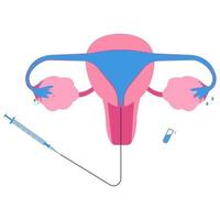 Hysterosalpingogram or HSG, x-ray procedure used to see fallopian tubes and uterus condition. Female reproduction test. vector