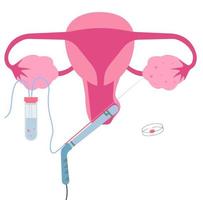 recuperación de ovocitos transvaginal, uno de fertilización in vitro o procedimiento de fecundación in vitro. vector