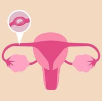 Ectopic pregnancy or fallopian tubes pregnancy. vector