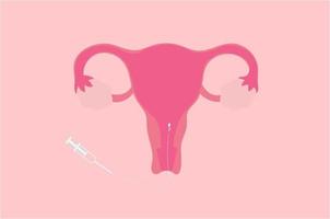 Vector illustration of intrauterine insemination or IUI