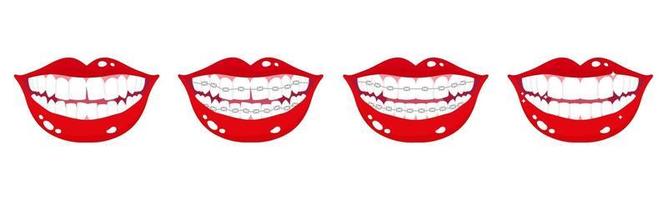 Conjunto de dibujos animados vectoriales de bocas sonrientes con etapas de alineación de los dientes con aparatos de ortodoncia metálicos sobre un fondo blanco. vector