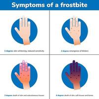 Simptoms of a frostbite 4 medical stages Infographic vector