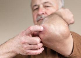 Psoriasis on the elbow photo