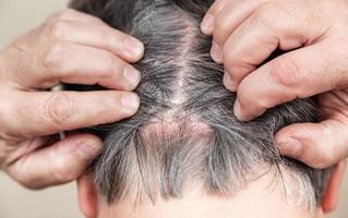 Psoriatic skin disease in hair photo