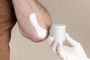 A dermatologist in gloves applies a therapeutic ointment to the affected skin of a patient with psoriasis photo