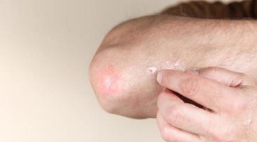 Psoriasis on the elbow photo