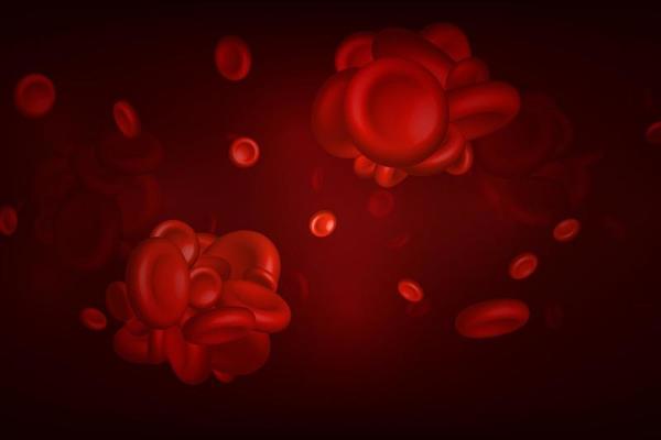 Blood clots thrombus or embolus with coagulated erythrocytes