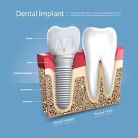 Ilustración de vector de dientes humanos e implantes dentales
