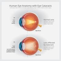 anatomía del ojo con anomalías oculares ilustración vectorial vector